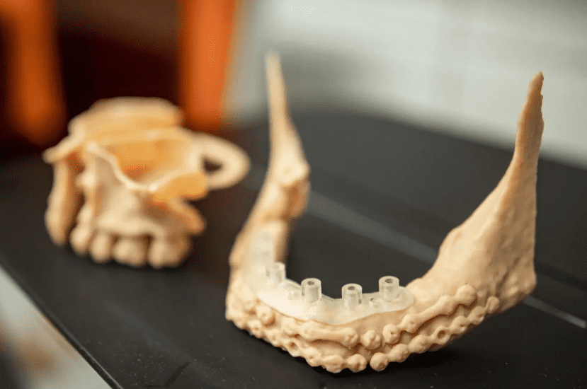 3D nyomtatott fogászati modell