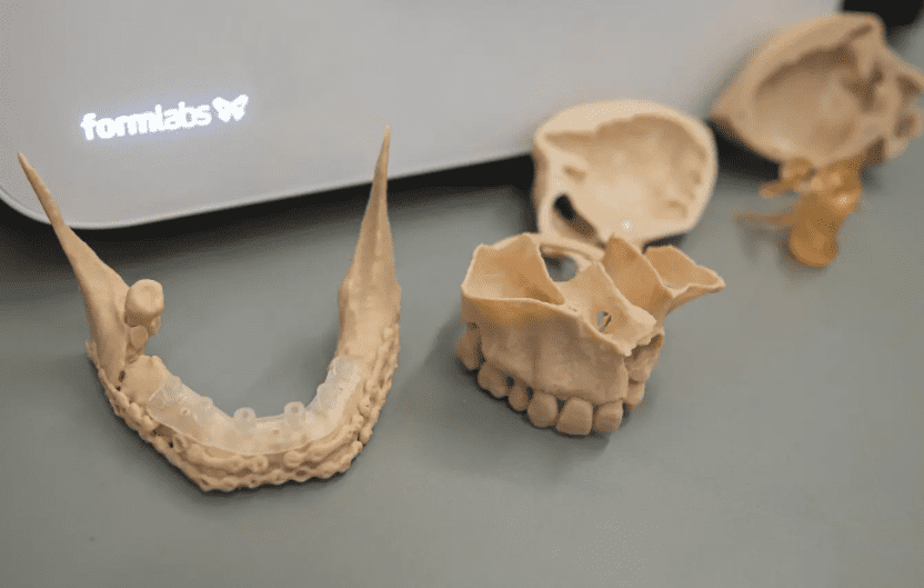 3D nyomtatott implantátum, csont és állkapocs modellek